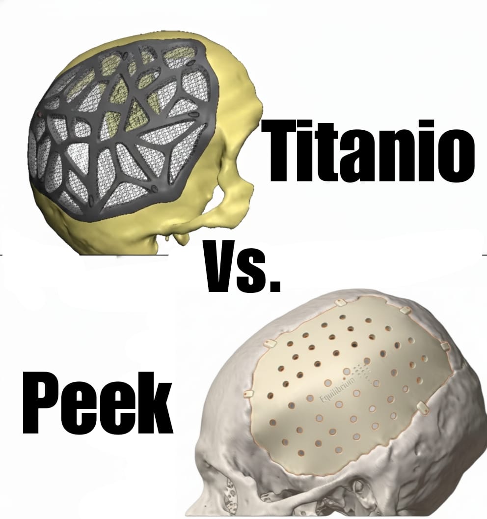Implantes personalizados Equilibrium